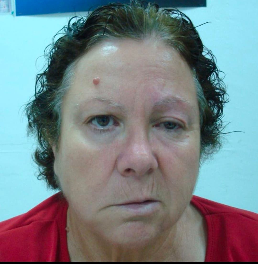 Paralysis & Facial Paralysis
